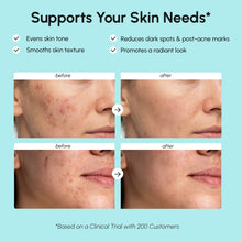 Azelaic Acid Cream for Sensitive Skin
