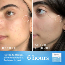 Ultra-Strength Microdart Acne Patch